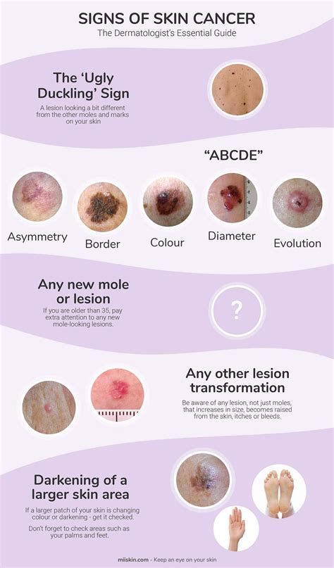 what are the signs of melanoma skin cancer